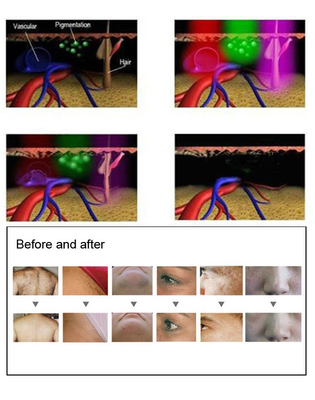 480nm 530nm SHR Diode Laser Hair Removal IPL Ice Cold Beauty Equipment