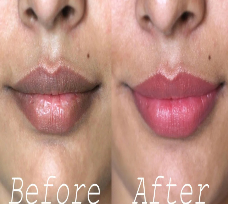 Stalideram Brand Pink Lip Injection Treatment Serum Derma Microneedling Mesotherapy Lip Repair Essence