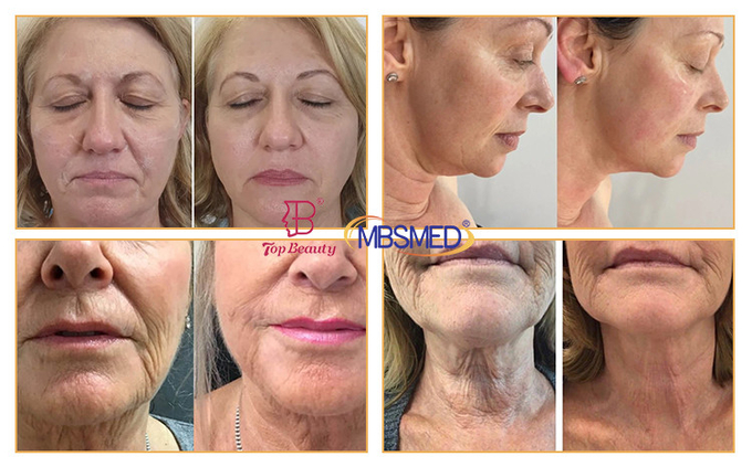 7D 12D 14D ICE HIFU Face Lifting Wrinkle Removal HIFU Machine