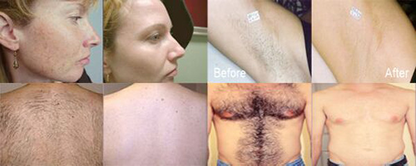 FDA approved ipl laser machine ipl laser hair removel machine for sale lumenis ipl quantum