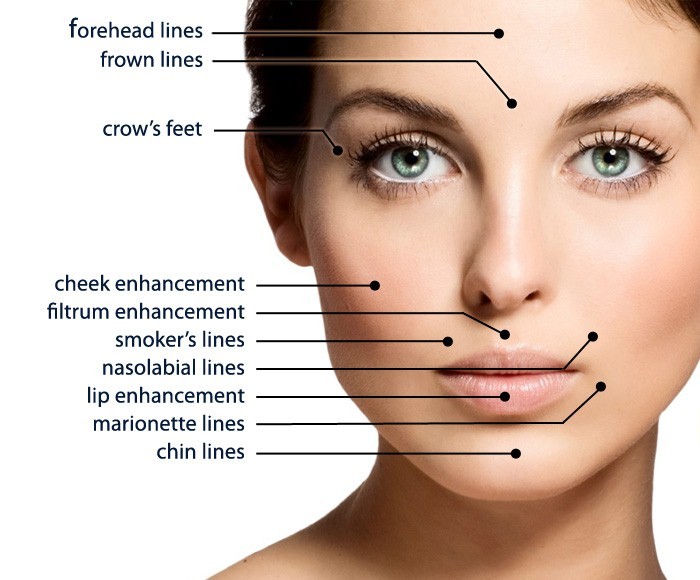 Absorbable 3D Cog Pdo Eye Thread Lift Threading To Lift Face L Blunt