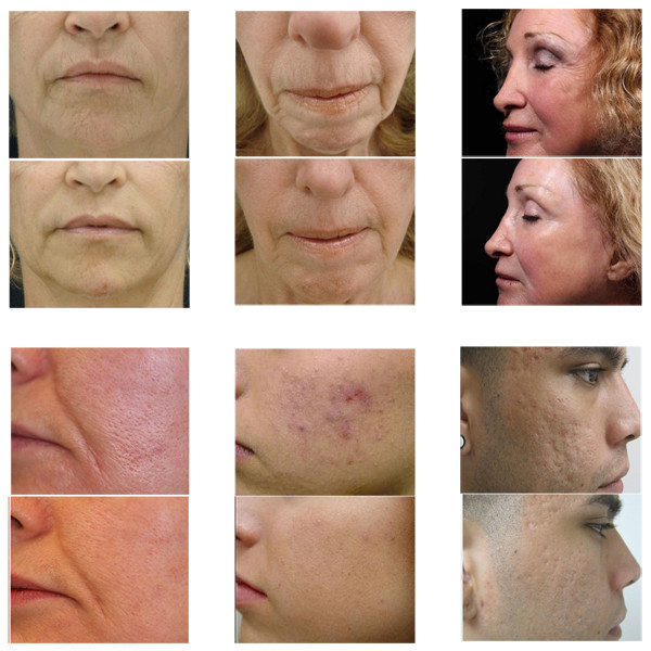 Skin maintenance microneedle nurse system Fractional radiofrequency micro needling