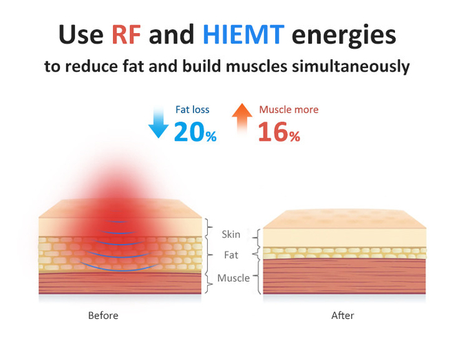 Achieve Your Ideal Physique with EMS Muscle Sculptor 14 Tesla HlEMT Intensity and RF Temperature
