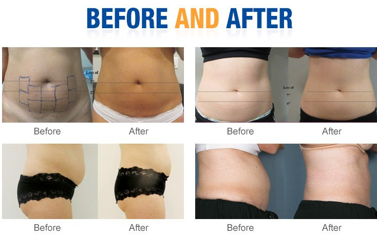 Non - Surgical Safe Liposonix HIFU Beauty Machine For Body Slimming / Skin Tightenin