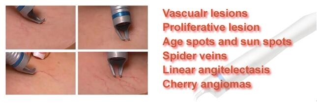 Vein Vascular removal equipment 980nm Spider Vein Vascular removal 980nm diode laser vascular removal