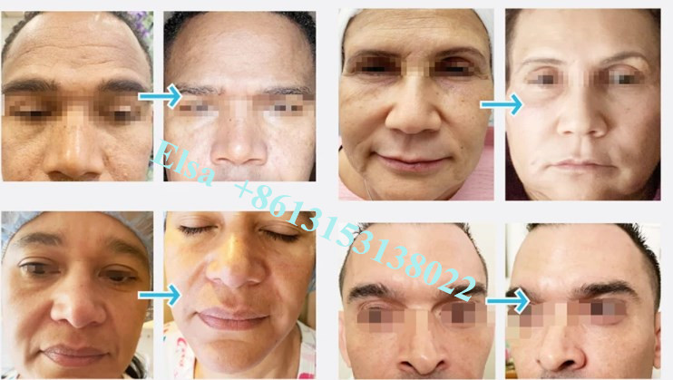 Hyaluronic Acid Gel Injection Juvederm Lip Filler Ce Anti Aging 1ml 2ml 5ml