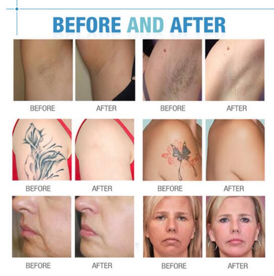 double handles elight IPL facial hair removal