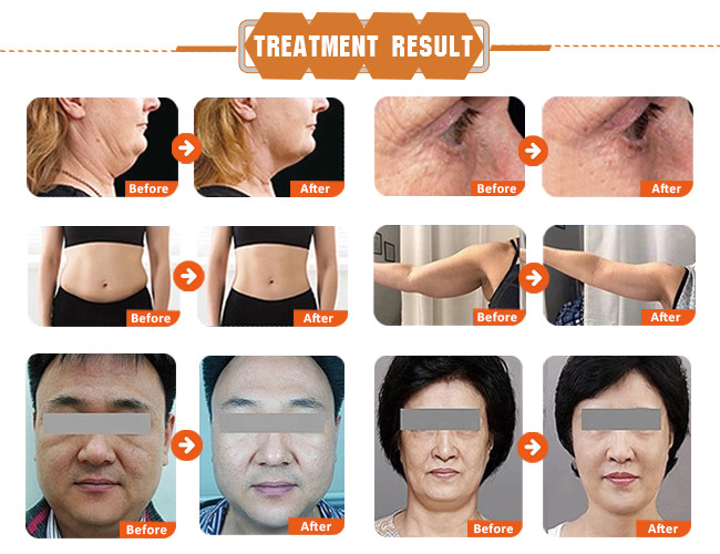 25mm HIFU Slimming Machine 3d Portable Hifu Ultrasound Facelift