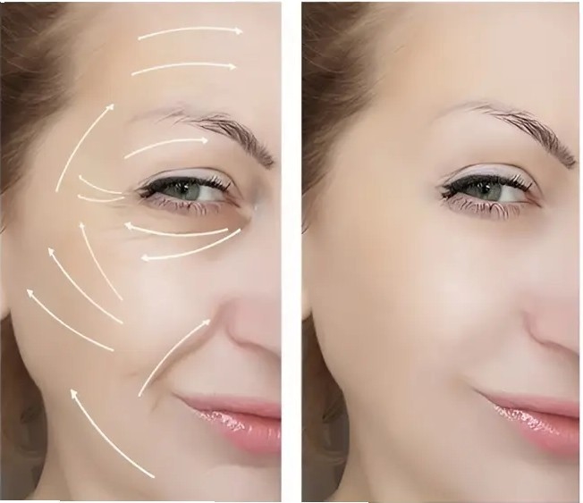 HA Chin Neuramis Deep Lip Filler Facial Dermal Filler For Forehead Lines
