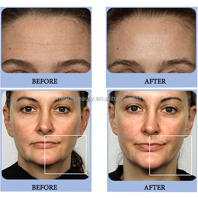 UK Plugs Face Muscle Stimulator Machine STANDING For Skin Tightening