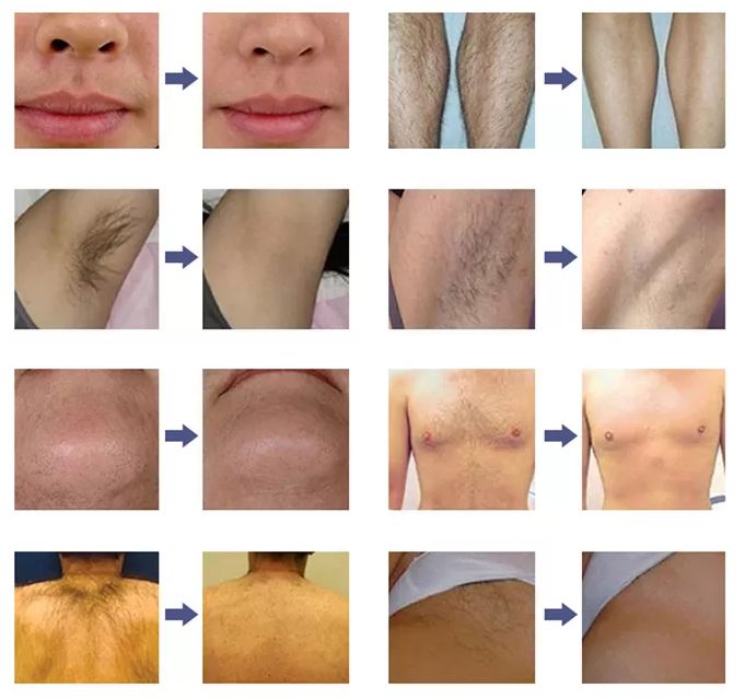OPT Nd Yag Diode Laser Hair Removal Machine 2 In 1 Picosecond Skin Rejuvenation