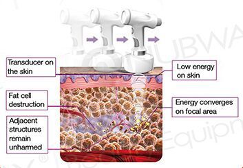 high intensity focused ultrasound slimming machine/hifu slimming for body shape ultrashape hifu machine