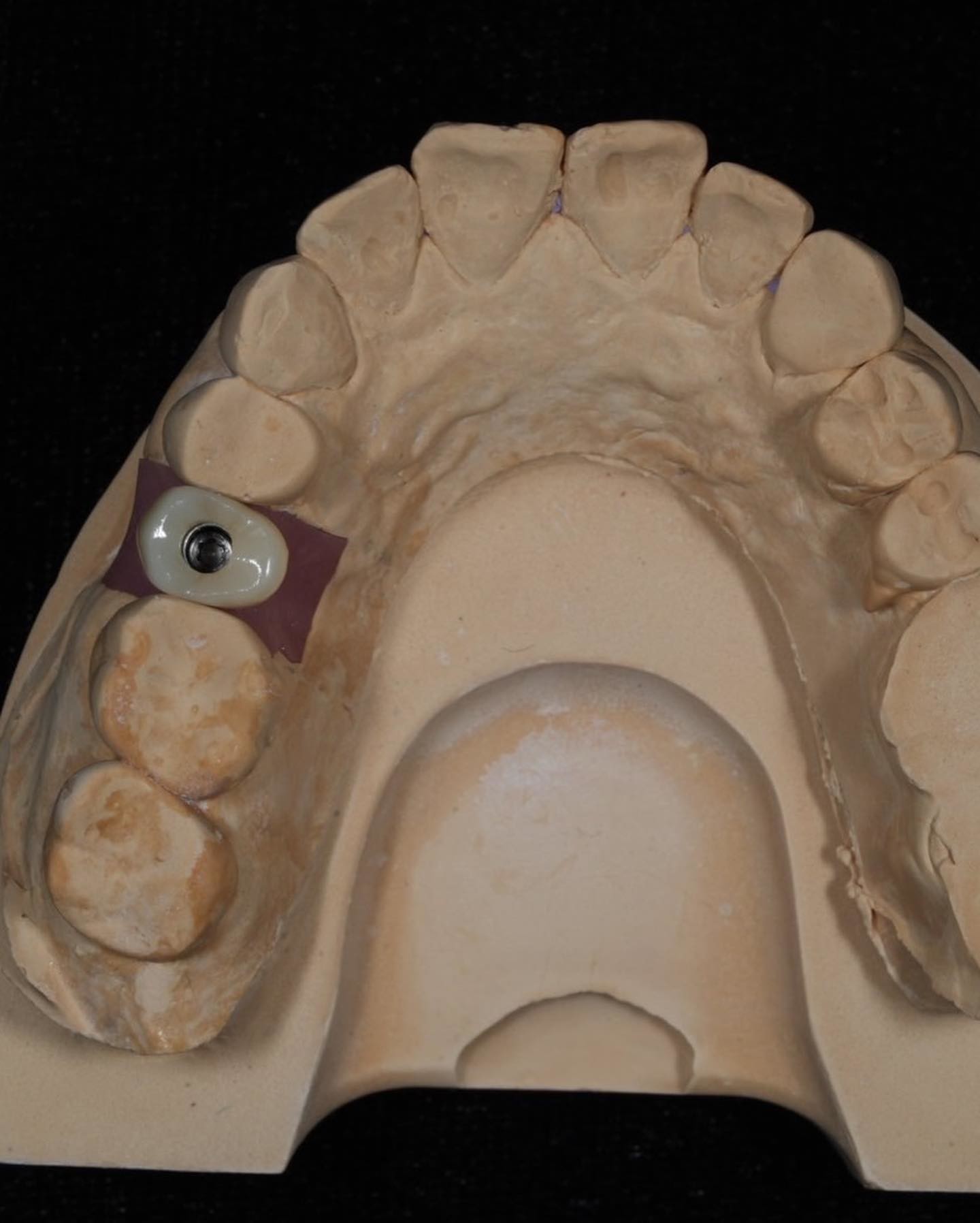 Screw Cement Retained Implant For Long-Lasting Dental Implants With 5-Year Guarantee