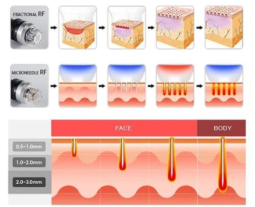 Popular Ce Fractional Rf Microneedle Machine Noninvasively