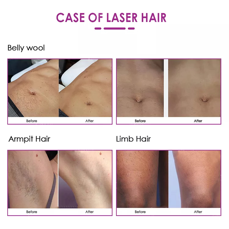 OEM Portable Professional 808nm Diode Laser Hair Removal Machine