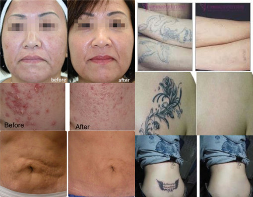 q switched nd yag laser vertical laser tattoo removal machine