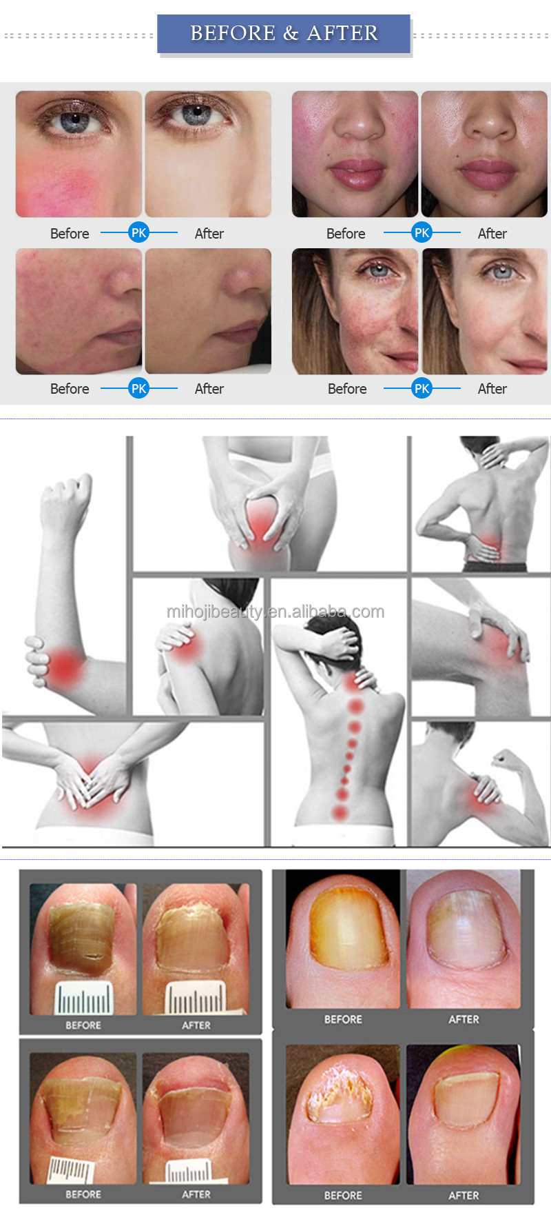980nm Portable Vascular Removal Machine For Spider Vein Blood Vessels