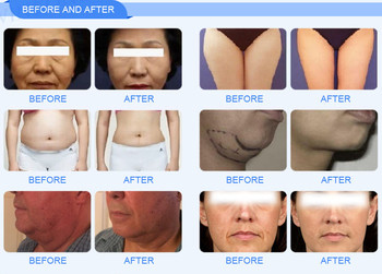 High Intensity Focused Ultrasound HIFU 3D Machine 1-11 Lines Skin Tightening Lifting