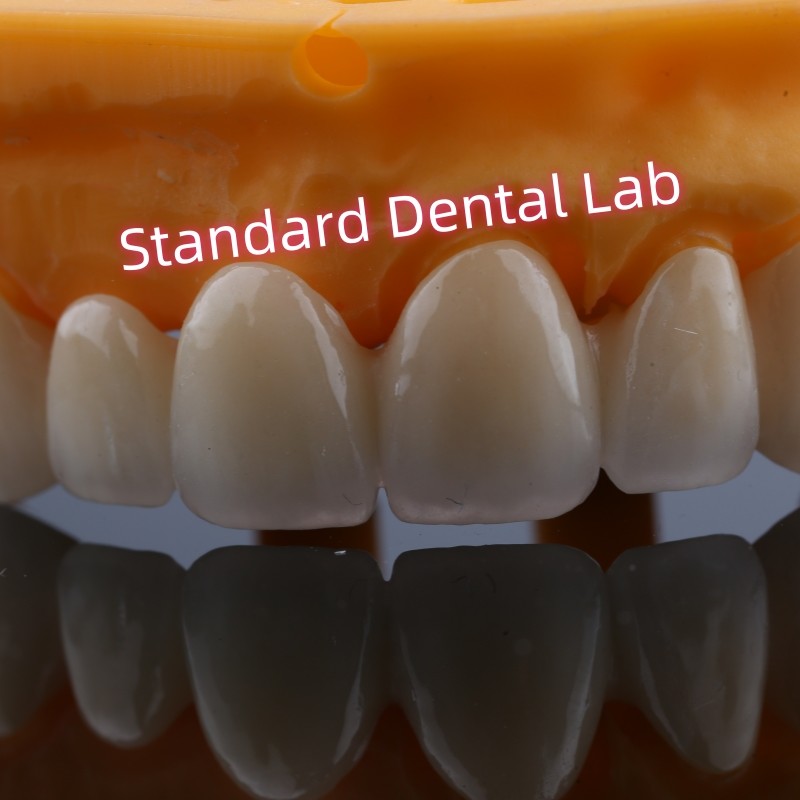 Anterior Restoration Zirconia Bridge Crowns For Missing Teeth