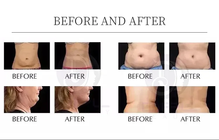 80K Vacuum Cavitation System 9 In 1Cavitation Machine Body Slimming Machine Skin Tightening