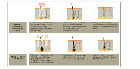 Permanent diode laser hair removal machine for Spa or Salon use