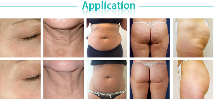 Multifunction Fat Reduction Cavitation Vacuum RF Body Slimming Machine Fast Cavitation Slimming System