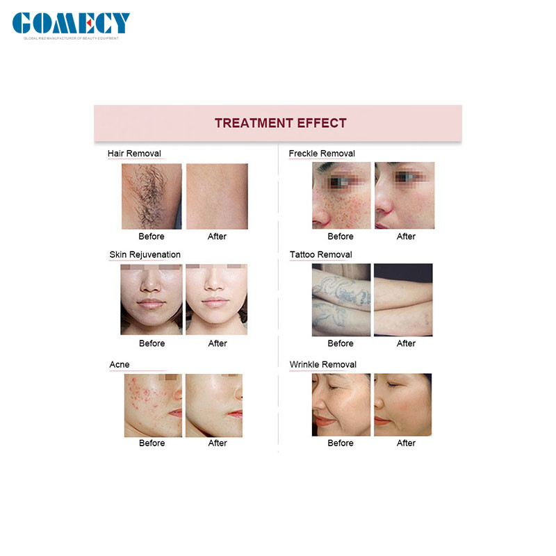 Stellar M22 SHR 2 IN 1 IPL RF Laser Beauty Equipment OPT Permanent Hair Removal