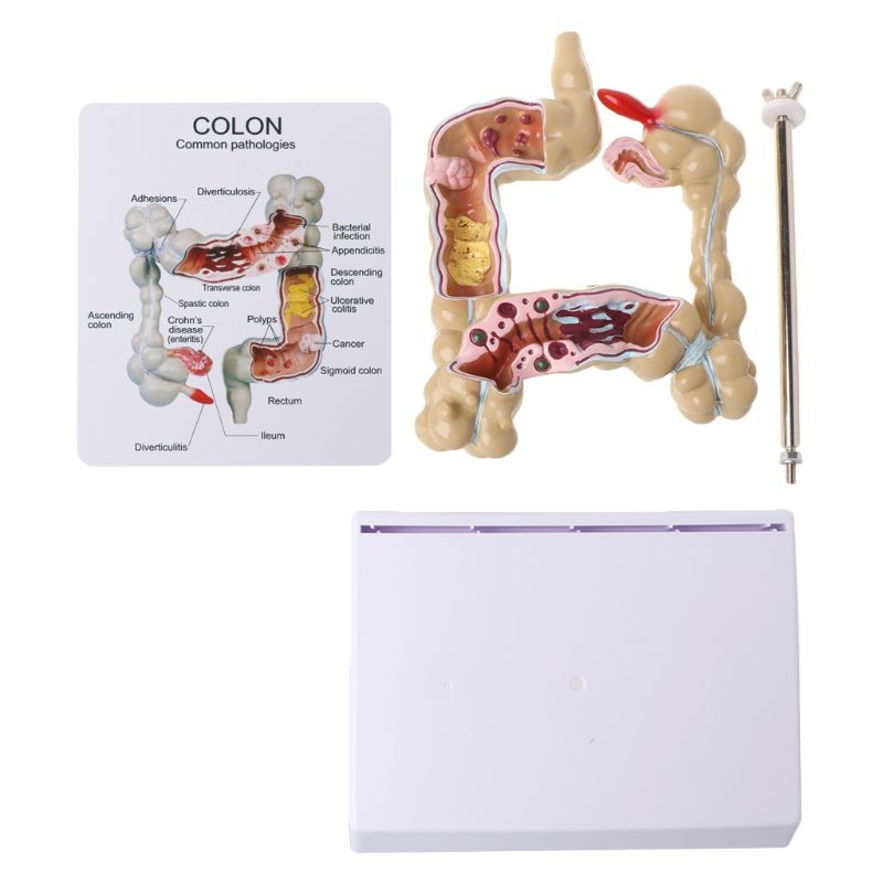 Colon Pathology 22.5cm Human Anatomy Model As Medical Teaching Learning Tool