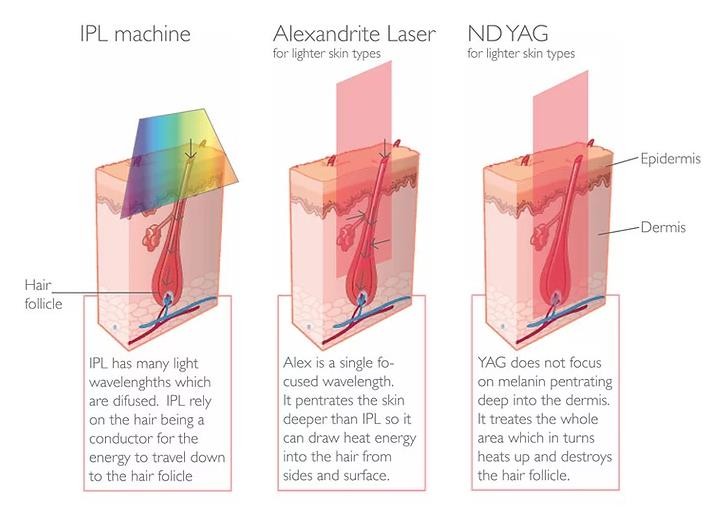 CE Approved Vertical Shr Ipl Machine For Beauty Salon