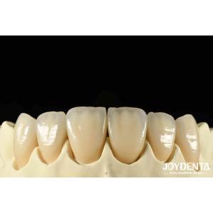 Bionic Development Leaves And Distinct Layers Of Zirconia All-Ceramic