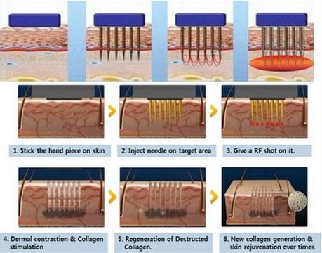 CE approved Nubway high quality 2015 big promotion fractional RF & microneedle RF device for face lifting