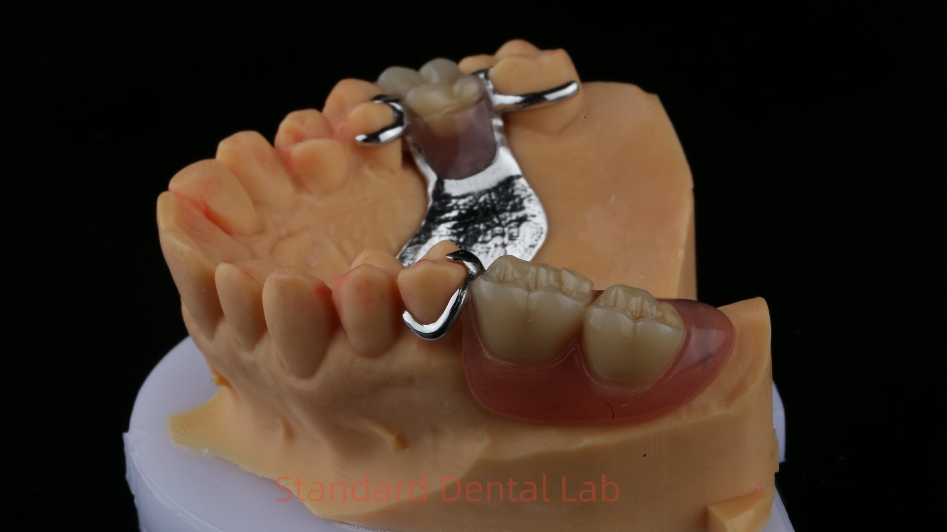 Partial Cobalt Chrome Dentures Ivoclar Scheftner Comfortable Metal Framework Delivered in Just 3 Days