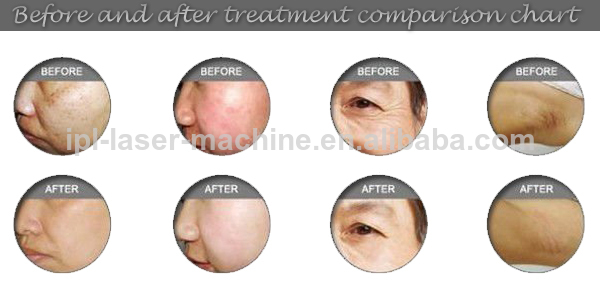high frequency IPL laser hair removal Skin lighten acne wrinkle removal machine
