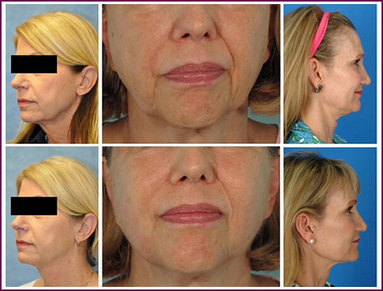 facelifting ultrasound machine hifu