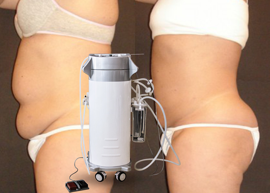 Surgical Hip Liposuction Fat Slimming Machine 300W Input Power OEM / ODM