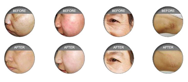 Pain free equipment for beauty salon SHR best professional ipl machine for hair removal