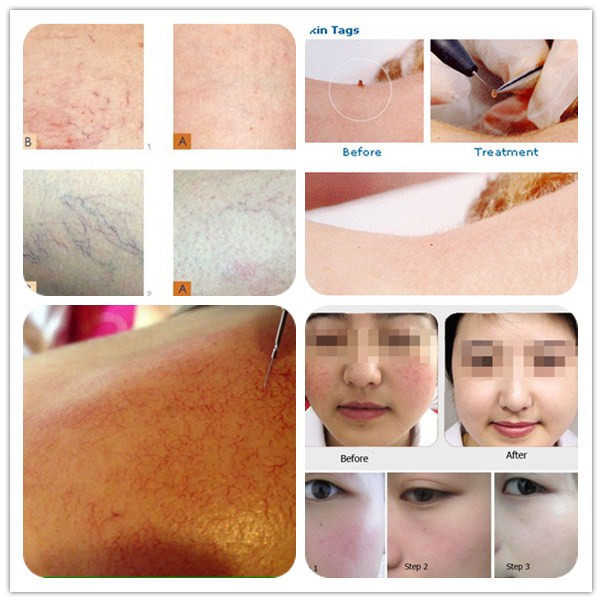 2015 latest portable vascular therapy effective treating spider vein
