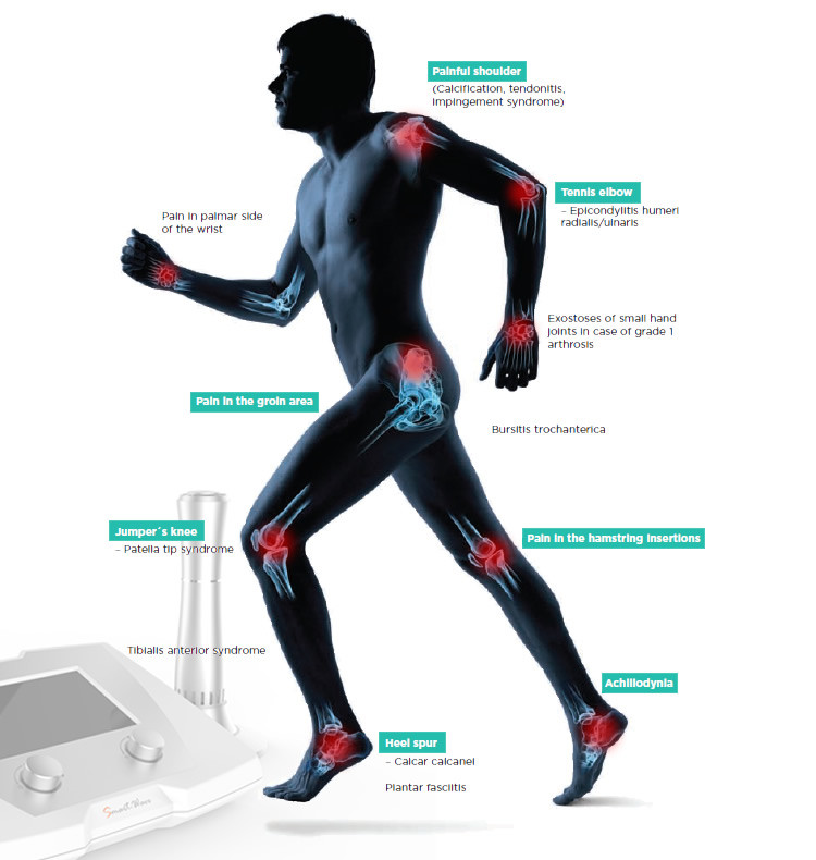 22Hz Extracorporeal Acoustic Wave Therapy Equipment Erectile Dysfunction treatment