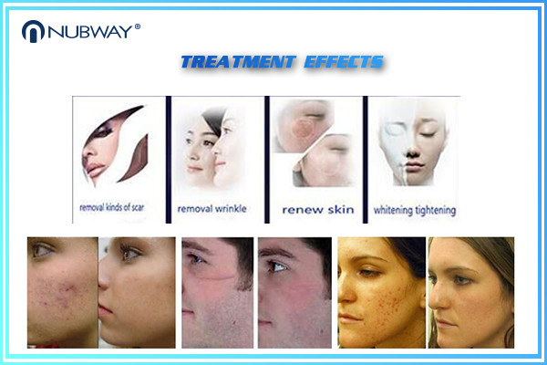 new design beauty equipment carboxytherapy machine fractional co2 laser