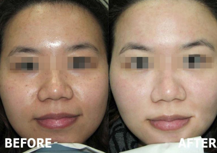 Whitening Youth Serum Injection Mesotherapy Skin Care Vitamin C Serum