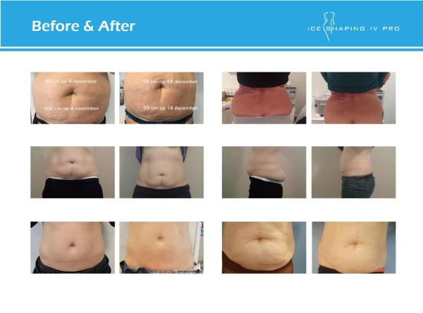 China top 10 supplier's CE approved 4 handles coolsculpting technology fat