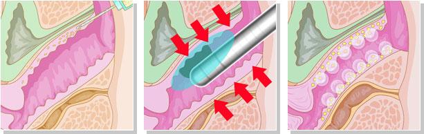Non Surgical Hifu Cellulite Reduction Machine Face Lifting Body Firming Vaginal Tighten