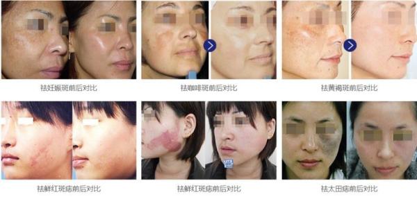 1064nm 532 nm 1320nm Q Switched Nd Yag Laser Machine :Pigment removal,Tattoo