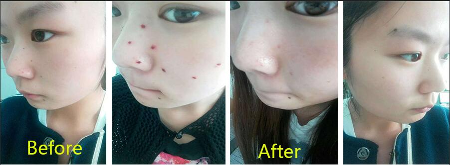 Good Price!! Beauty Device Tattoo Remove Laser Machine/Q Switch ND Yag Laser with CE