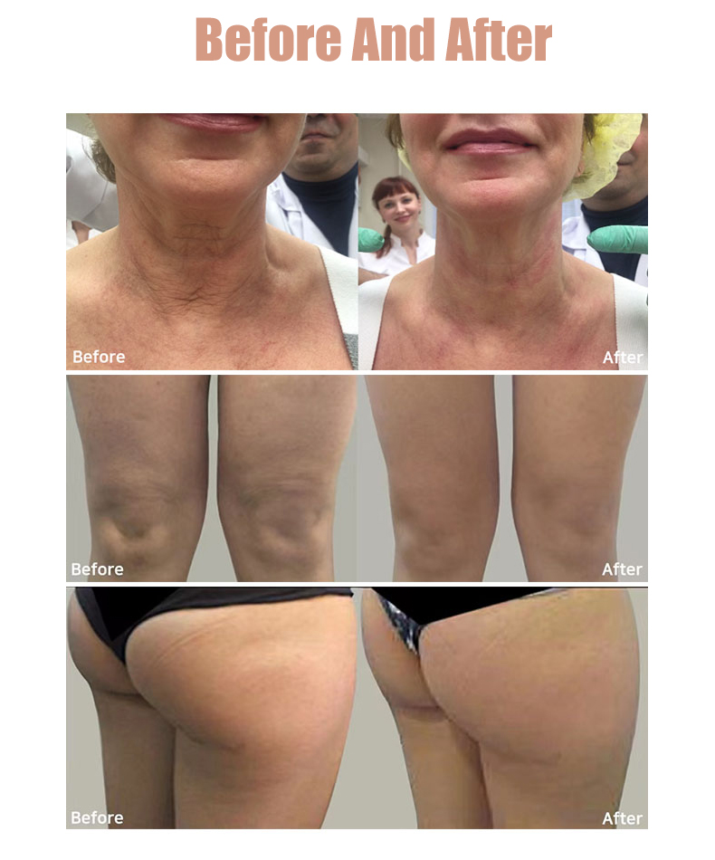 Multi-functional MFU RF HIFU Machine for Face and Body Skin Tightening and Lifting with 4 Handles and 10 Cartridges