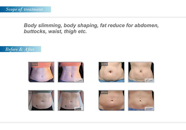 Sale!!! new designed HIFUSHAPE slimming machine, portable ultrasound device