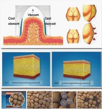 Fat Effective Cryolipolysis Machine,Cryolipolysis Slimming Machine,Cryolipolysis Equipment
