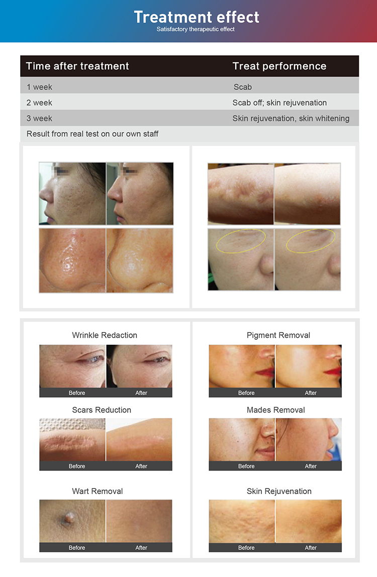 Professional 60W RF Tube Q-Switch Fotona Fractional CO2 Laser Skin Resurfacing Machine