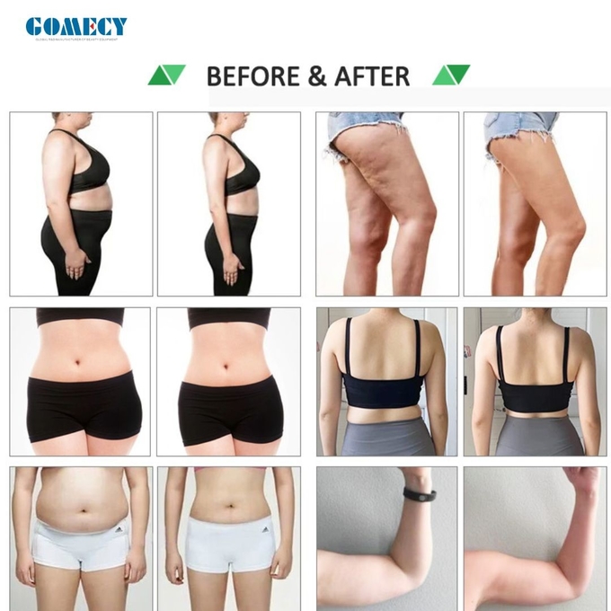 10D Laser Body Shaping Machine Fat Removal High Power 532nm Laser Weight Loss Cold Light
