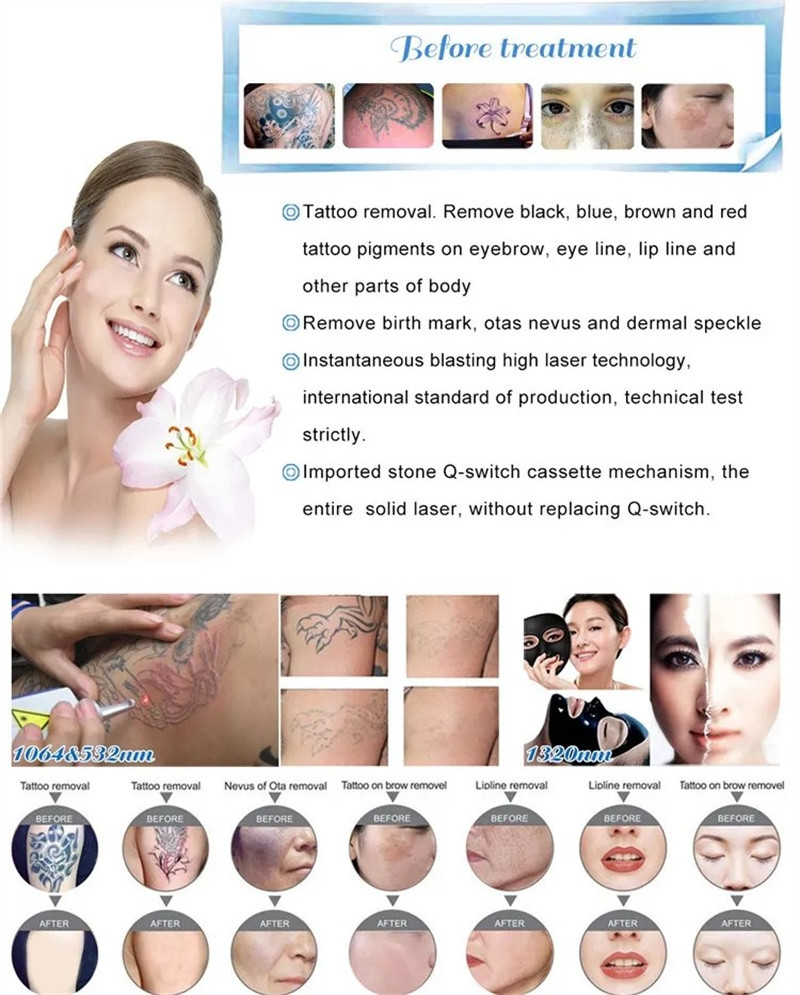 Vertical Tattoo Removal Pico Laser Machine Q Switched Nd Yag